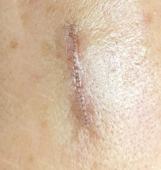 缝合皮肤用什么针【你知道吗】小来兼可隐针锋，一寸拈来一寸情——三种缝合技术让您的伤口“美”得无痕_https://www.jmylbn.com_新闻资讯_第8张