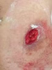 尿液引流袋怎么倒掉【大众健康】泌尿造口护理小妙招_https://www.jmylbn.com_新闻资讯_第11张