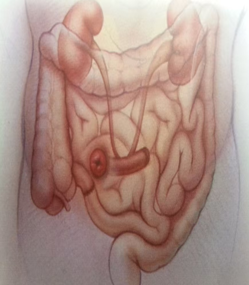 尿液引流袋怎么倒掉【大众健康】泌尿造口护理小妙招_https://www.jmylbn.com_新闻资讯_第4张