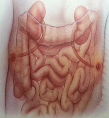 尿液引流袋怎么倒掉【大众健康】泌尿造口护理小妙招_https://www.jmylbn.com_新闻资讯_第5张