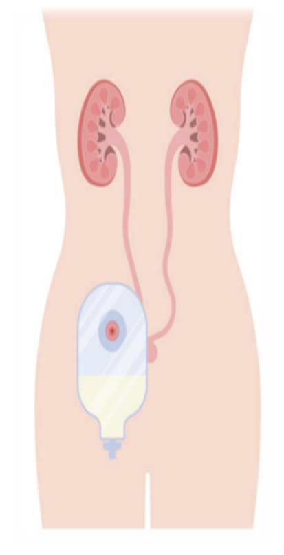 尿液引流袋怎么倒掉【大众健康】泌尿造口护理小妙招_https://www.jmylbn.com_新闻资讯_第2张