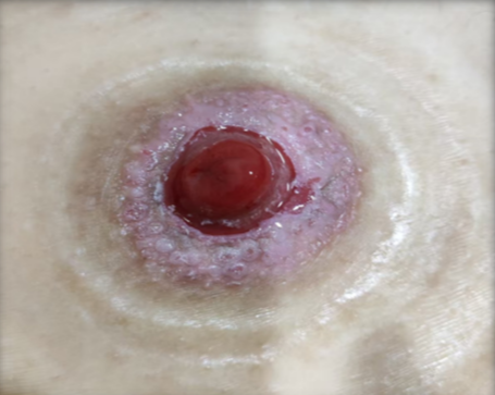 尿液引流袋怎么倒掉【大众健康】泌尿造口护理小妙招_https://www.jmylbn.com_新闻资讯_第9张