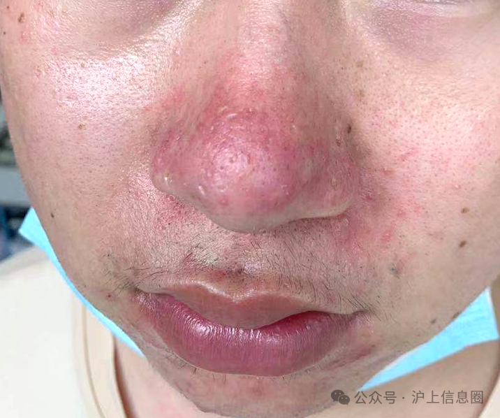 【皮肤健康】酒糟鼻的治疗方法有哪些呢