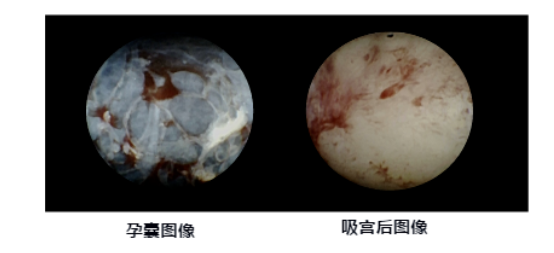 人流吸引管怎么选择爱康医院人流手术‖全程呵护子宫，全面护理，让你恢复如初_https://www.jmylbn.com_新闻资讯_第11张