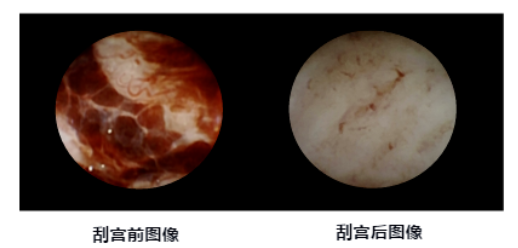 人流吸引管怎么选择爱康医院人流手术‖全程呵护子宫，全面护理，让你恢复如初_https://www.jmylbn.com_新闻资讯_第10张