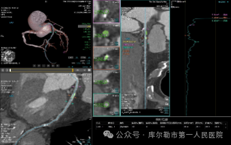 医院仪器怎么成像【医院动态】库尔勒市第一人民医院医学影像科引进新设备，助推医院高质量发展_https://www.jmylbn.com_新闻资讯_第8张
