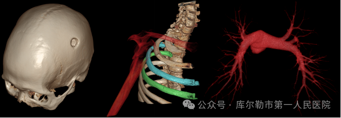 医院仪器怎么成像【医院动态】库尔勒市第一人民医院医学影像科引进新设备，助推医院高质量发展_https://www.jmylbn.com_新闻资讯_第16张