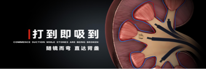 输尿管鞘是什么肾输尿管结石治疗的又一“神器” ——头端可弯曲负压输尿管软镜鞘_https://www.jmylbn.com_新闻资讯_第3张