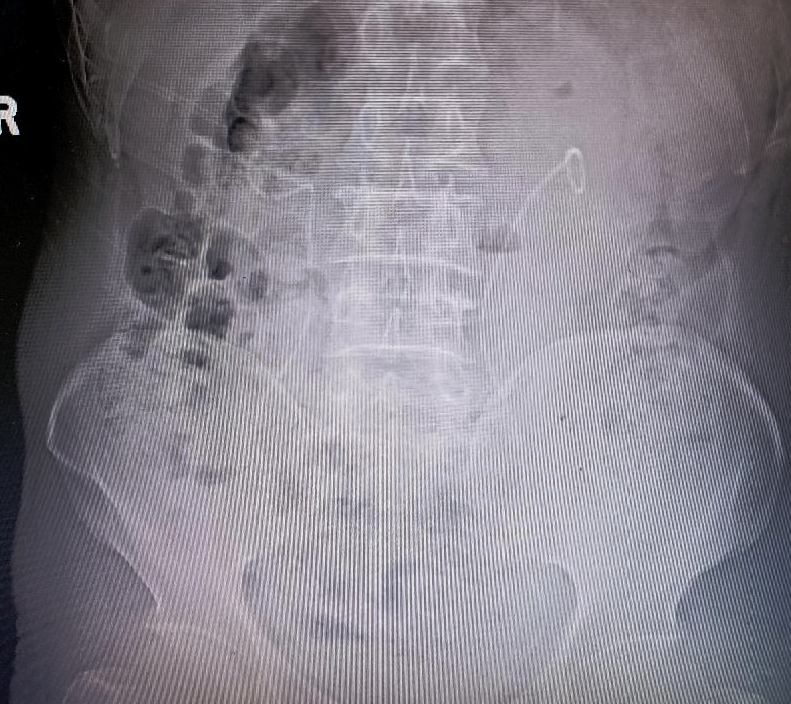 输尿管鞘是什么肾输尿管结石治疗的又一“神器” ——头端可弯曲负压输尿管软镜鞘_https://www.jmylbn.com_新闻资讯_第7张