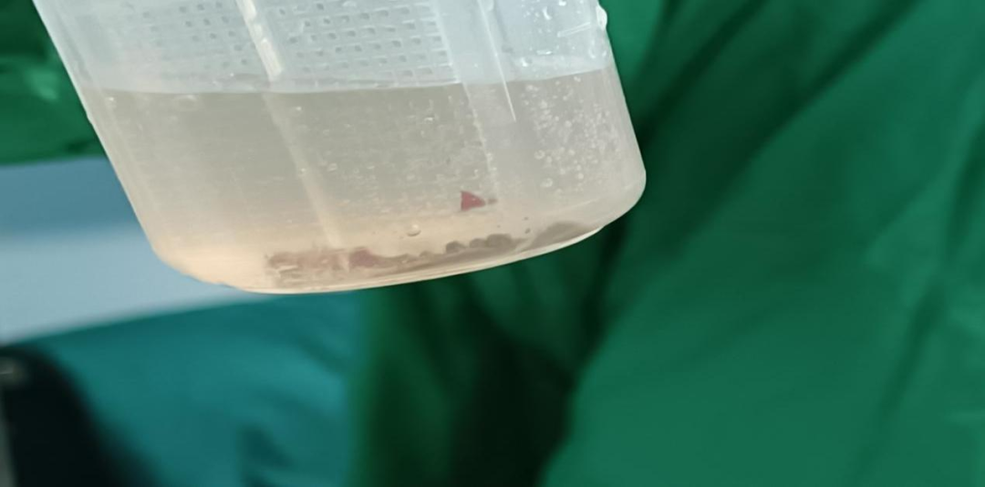 输尿管鞘是什么肾输尿管结石治疗的又一“神器” ——头端可弯曲负压输尿管软镜鞘_https://www.jmylbn.com_新闻资讯_第6张