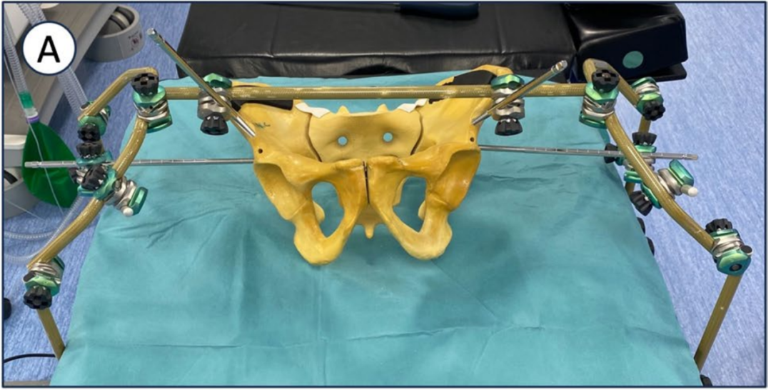 巧用外固定器：骨盆骨折经皮复位新方法