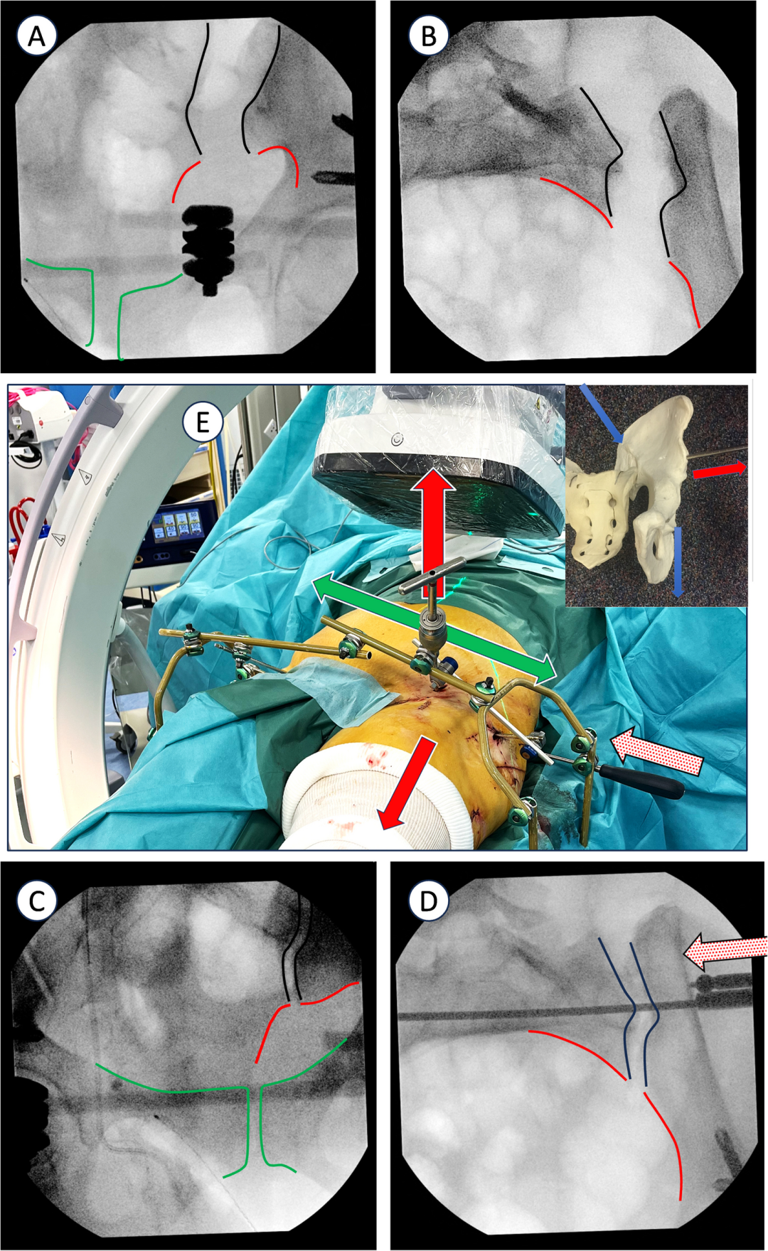 巧用外固定器：骨盆骨折经皮复位新方法