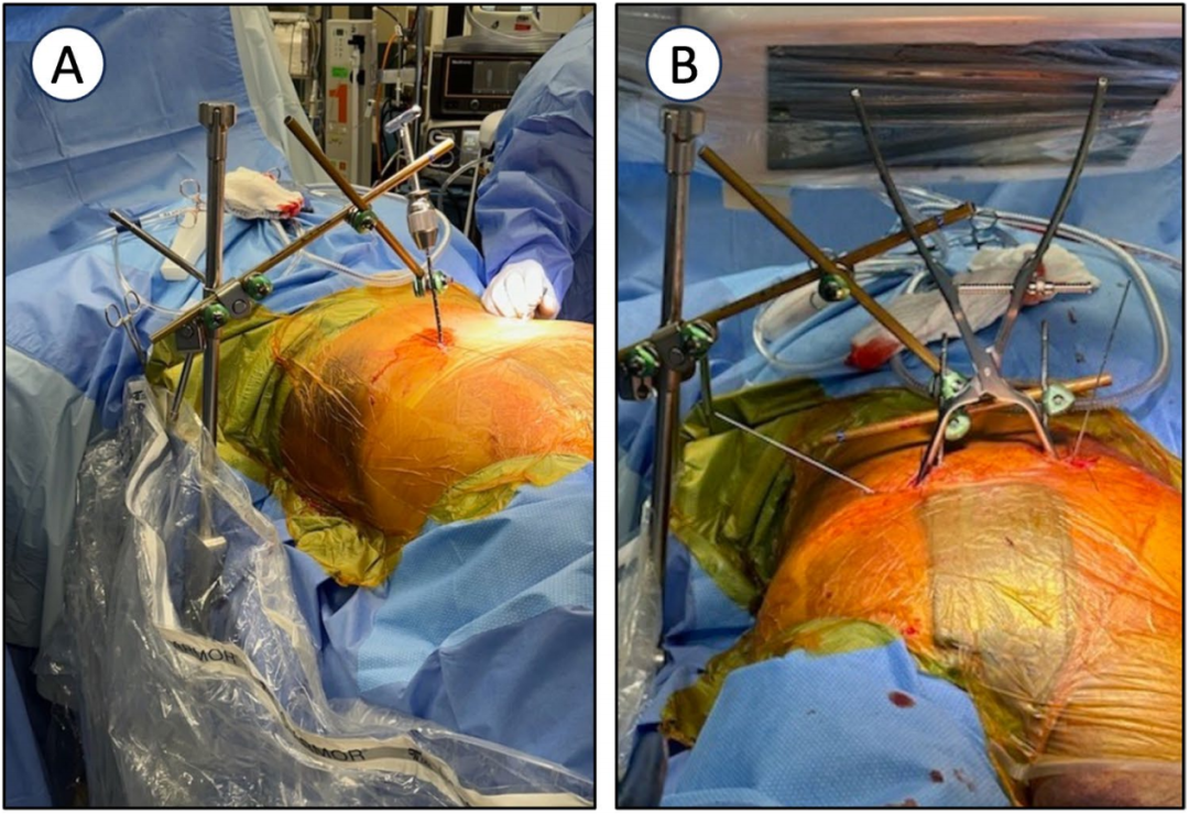 巧用外固定器：骨盆骨折经皮复位新方法
