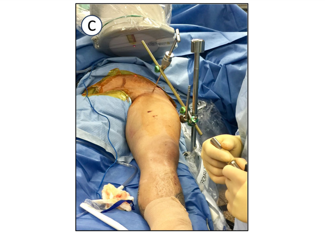 巧用外固定器：骨盆骨折经皮复位新方法