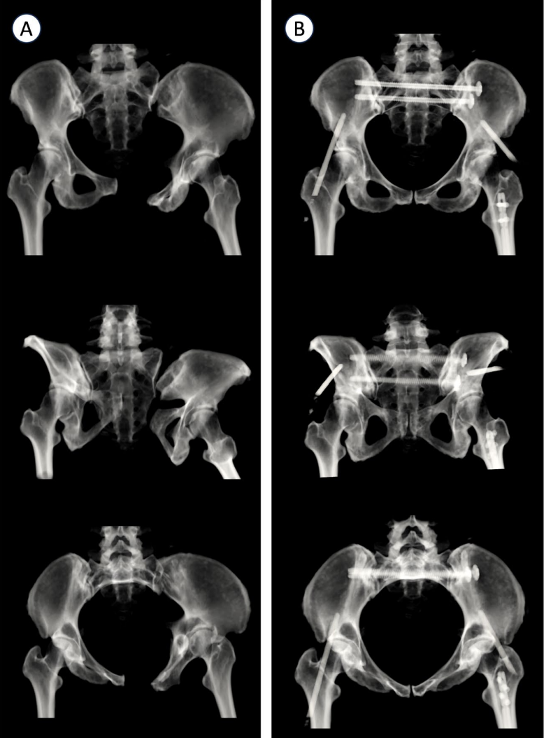 巧用外固定器：骨盆骨折经皮复位新方法