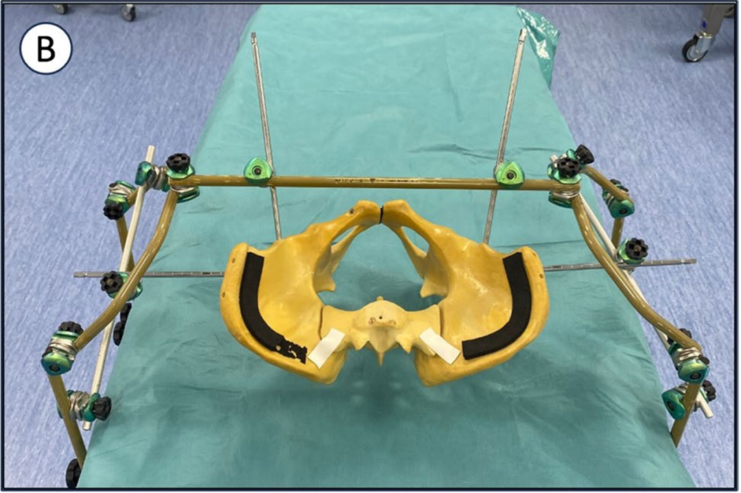 巧用外固定器：骨盆骨折经皮复位新方法