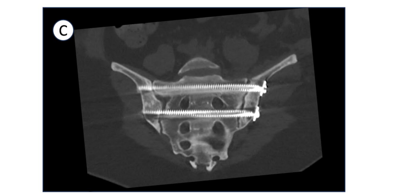 巧用外固定器：骨盆骨折经皮复位新方法