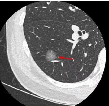 肺部结节 肺部结节