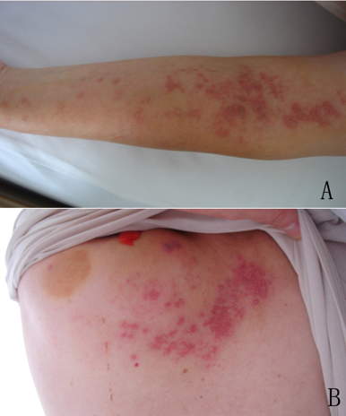 什么叫无影灯【无影灯下】“蛇缠腰”是什么病？你晓得不？_https://www.jmylbn.com_新闻资讯_第4张