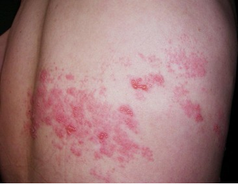 什么叫无影灯【无影灯下】“蛇缠腰”是什么病？你晓得不？_https://www.jmylbn.com_新闻资讯_第6张