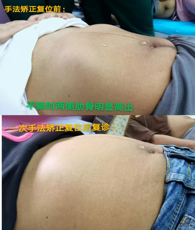 产后胸肋骨疼怎么回事产后妈妈容易忽略的健康问题——肋骨外翻_https://www.jmylbn.com_新闻资讯_第5张