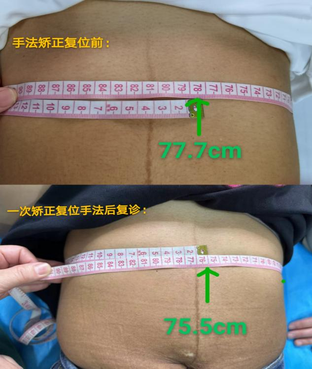 产后胸肋骨疼怎么回事产后妈妈容易忽略的健康问题——肋骨外翻_https://www.jmylbn.com_新闻资讯_第4张