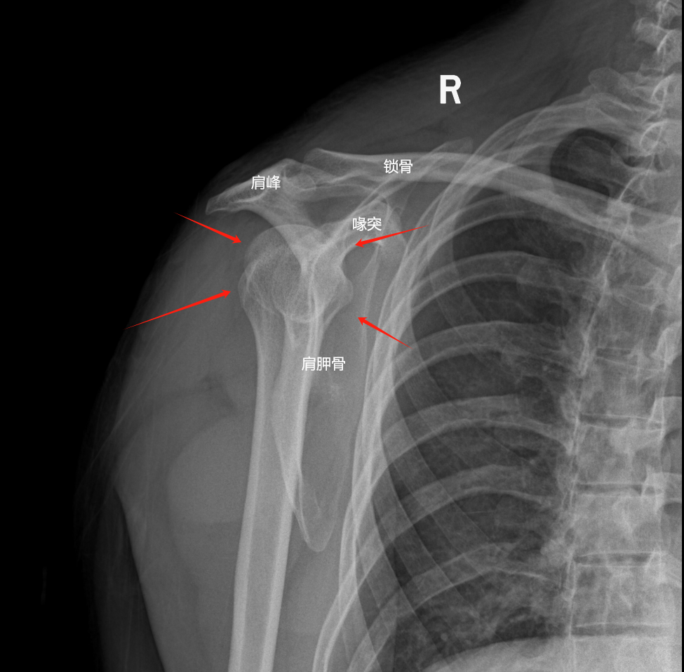 dr拍片怎么拍清晰骨折界的福尔摩斯：揭秘DR拍片如何让断骨“开口说话”_https://www.jmylbn.com_新闻资讯_第2张