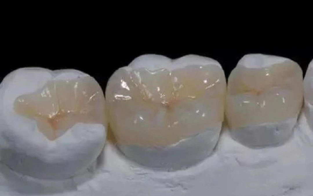 牙科材料硅胶怎么用如果你要做坏牙修复! 牙医告诉你怎么选材料和方案_https://www.jmylbn.com_新闻资讯_第7张