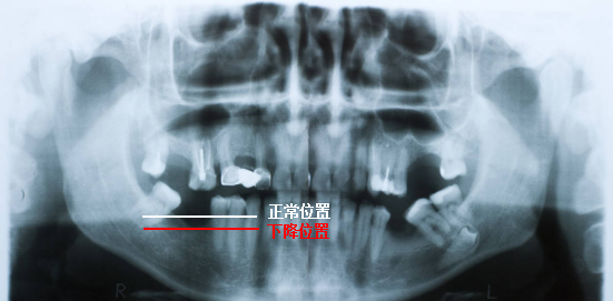 X光拍片为什么要等看牙为什么要拍片？非专业人士如何看懂自己的牙片！_https://www.jmylbn.com_新闻资讯_第12张