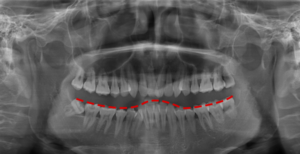 X光拍片为什么要等看牙为什么要拍片？非专业人士如何看懂自己的牙片！_https://www.jmylbn.com_新闻资讯_第15张