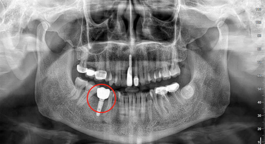 X光拍片为什么要等看牙为什么要拍片？非专业人士如何看懂自己的牙片！_https://www.jmylbn.com_新闻资讯_第11张