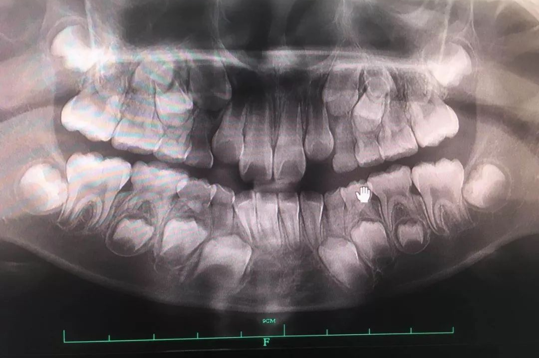 X光拍片为什么要等看牙为什么要拍片？非专业人士如何看懂自己的牙片！_https://www.jmylbn.com_新闻资讯_第14张