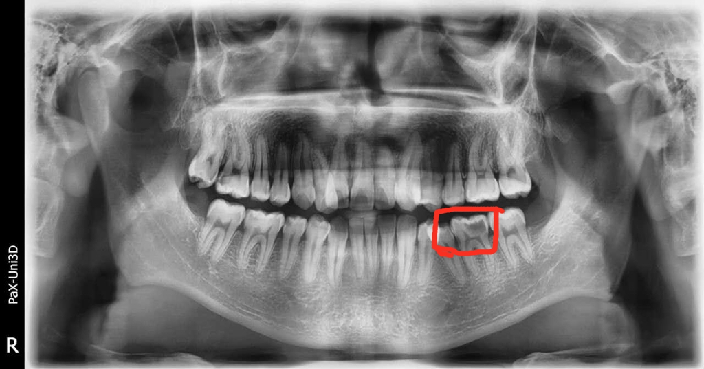 X光拍片为什么要等看牙为什么要拍片？非专业人士如何看懂自己的牙片！_https://www.jmylbn.com_新闻资讯_第9张