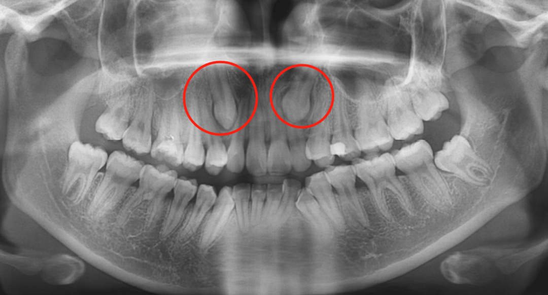 X光拍片为什么要等看牙为什么要拍片？非专业人士如何看懂自己的牙片！_https://www.jmylbn.com_新闻资讯_第13张