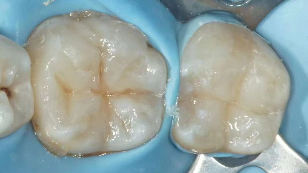 牙科材料硅胶怎么用如果你要做坏牙修复! 牙医告诉你怎么选材料和方案_https://www.jmylbn.com_新闻资讯_第5张