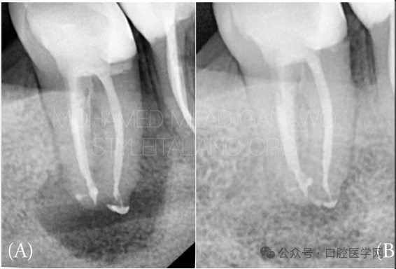 漂亮的C形根管再治疗