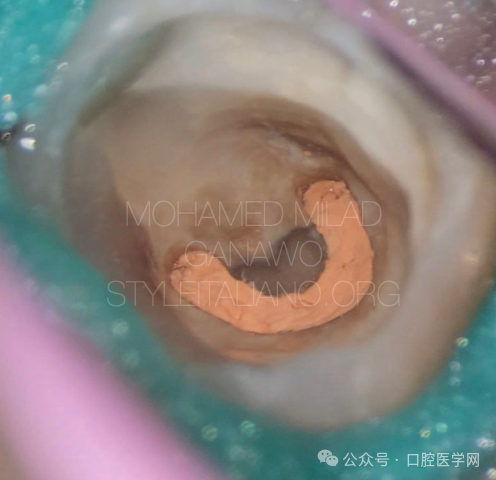 漂亮的C形根管再治疗