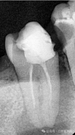 漂亮的C形根管再治疗