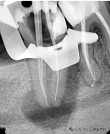 漂亮的C形根管再治疗