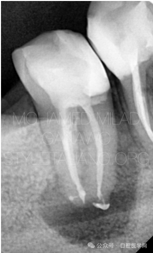 漂亮的C形根管再治疗