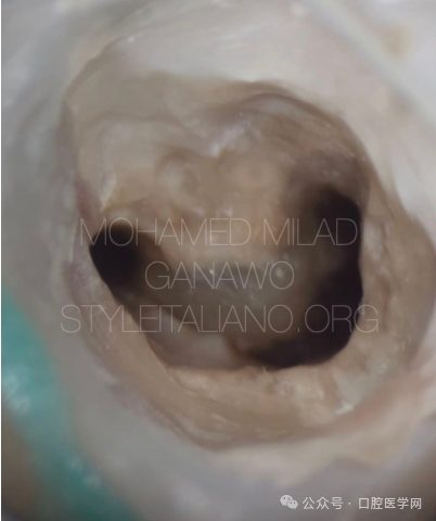 漂亮的C形根管再治疗