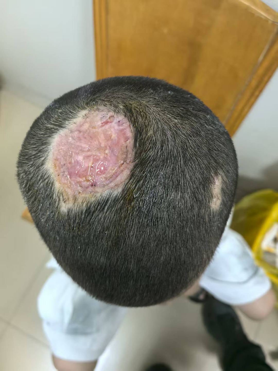 6岁男孩养兔子染真菌永久秃发