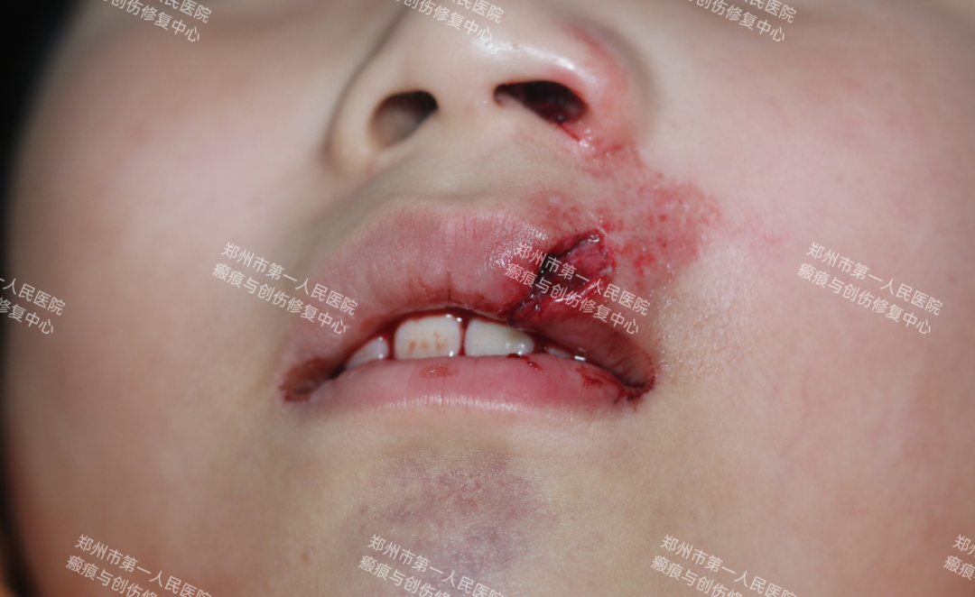 医生为什么缝合不用细线天衣无缝！“医”路相伴，急诊美容缝合对每一个伤口都温柔以待！_https://www.jmylbn.com_新闻资讯_第3张