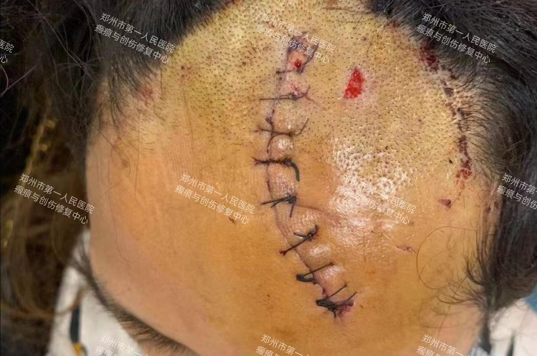 医生为什么缝合不用细线天衣无缝！“医”路相伴，急诊美容缝合对每一个伤口都温柔以待！_https://www.jmylbn.com_新闻资讯_第11张
