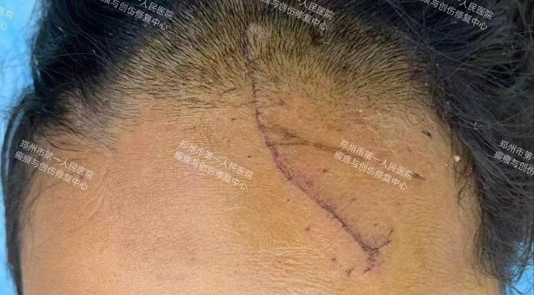 医生为什么缝合不用细线天衣无缝！“医”路相伴，急诊美容缝合对每一个伤口都温柔以待！_https://www.jmylbn.com_新闻资讯_第13张