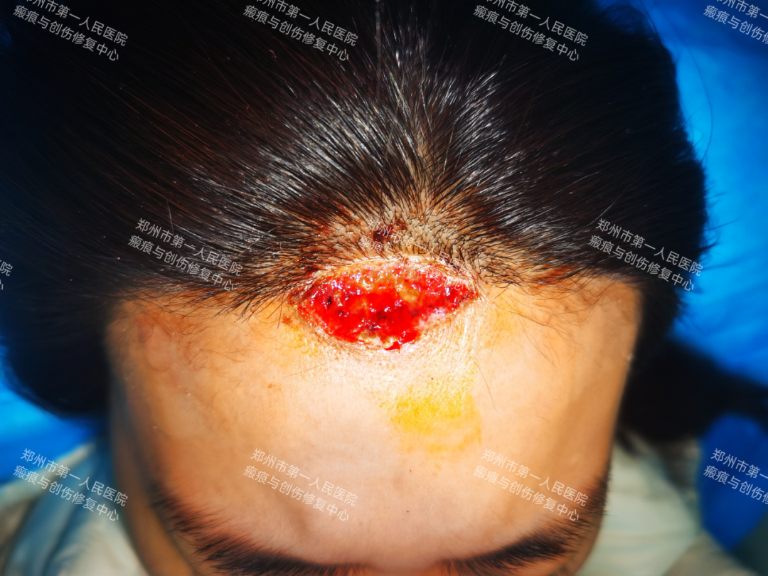 医生为什么缝合不用细线天衣无缝！“医”路相伴，急诊美容缝合对每一个伤口都温柔以待！_https://www.jmylbn.com_新闻资讯_第15张