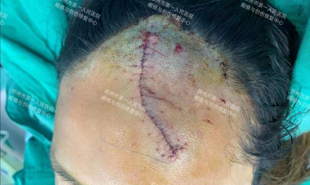 医生为什么缝合不用细线天衣无缝！“医”路相伴，急诊美容缝合对每一个伤口都温柔以待！_https://www.jmylbn.com_新闻资讯_第12张