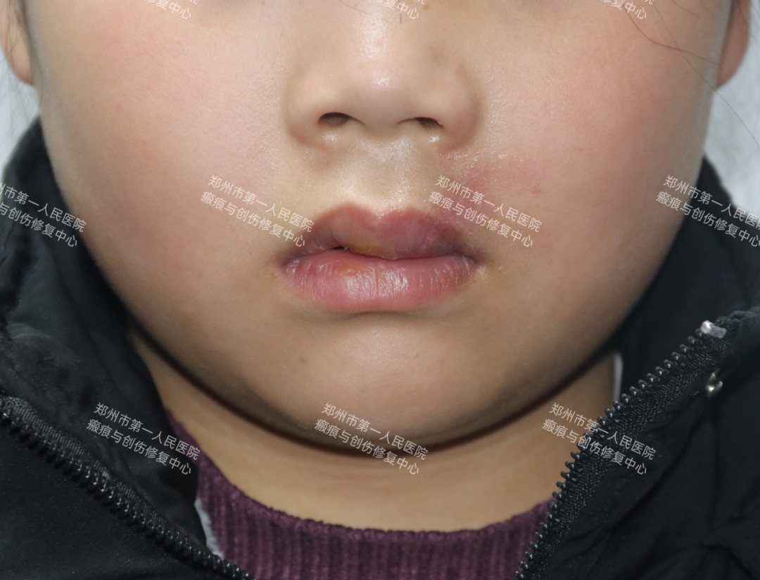 医生为什么缝合不用细线天衣无缝！“医”路相伴，急诊美容缝合对每一个伤口都温柔以待！_https://www.jmylbn.com_新闻资讯_第4张