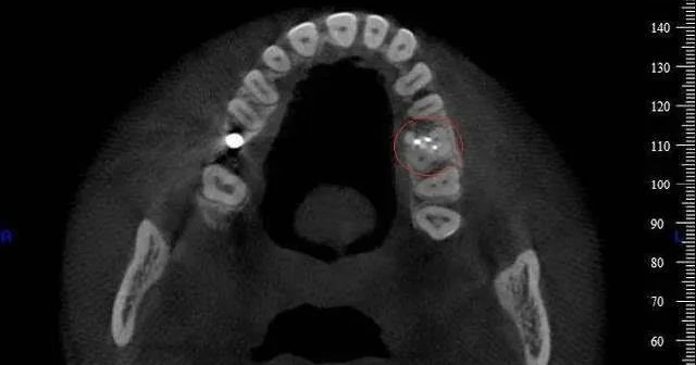口腔ct怎么拍摄【专科天地】没有口腔CT，你根本不会想到自己的牙齿长得多“奇葩”！_https://www.jmylbn.com_新闻资讯_第16张