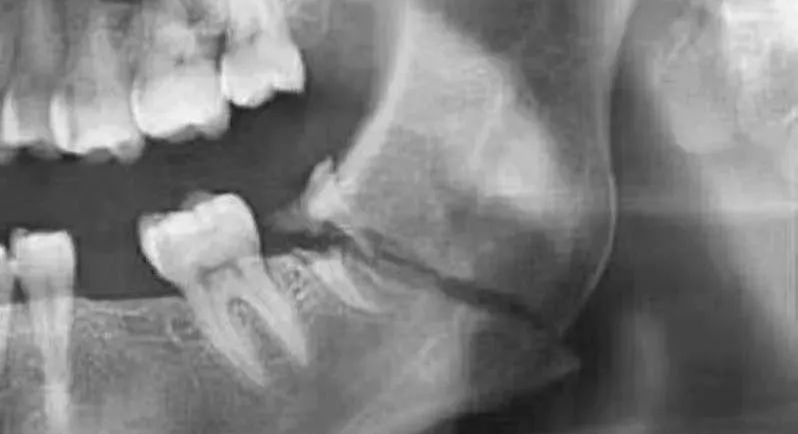 口腔ct怎么拍摄【专科天地】没有口腔CT，你根本不会想到自己的牙齿长得多“奇葩”！_https://www.jmylbn.com_新闻资讯_第10张